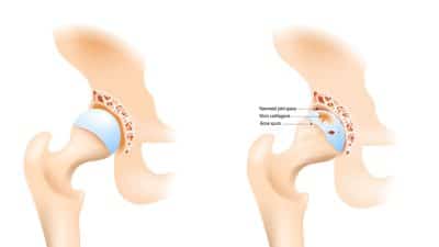 Hip joint with osteoarthritis with femoral head and the acetabulum of the pelvis. A comparison between a healthy hip joint and one with osteoarthritis, highlighting the key differences in structure. This can help patients understand diagnosis. Vector illustration with labeling and annotations for easily identifiable.