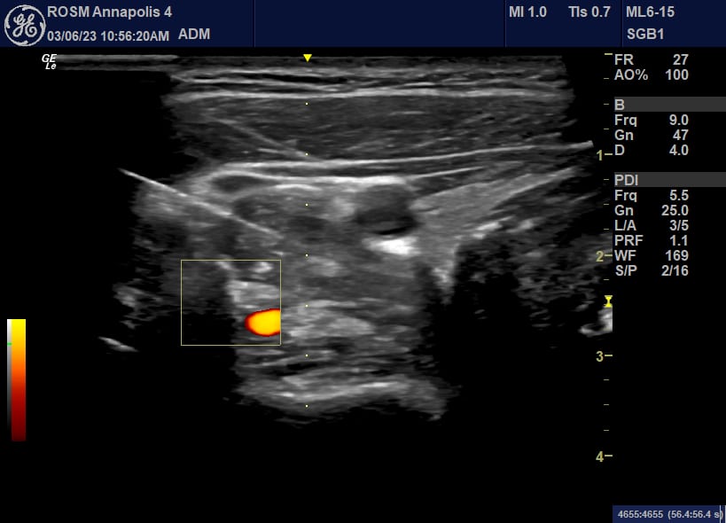 Ultrasound image used to guide a stellate ganglion block